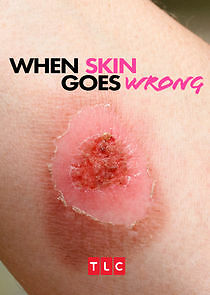 Watch When Skin Goes Wrong
