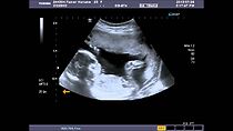 Watch Fetal Heart Echography