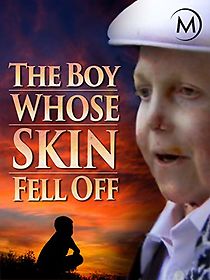 Watch The Boy Whose Skin Fell Off